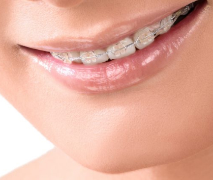 Laser-Assisted Root Canal Therapys